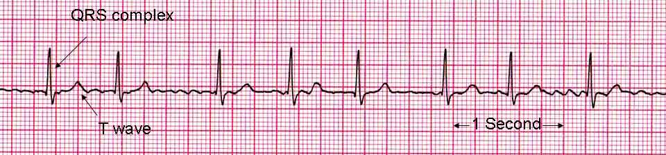 An ECG showing Atrial Fibrillation