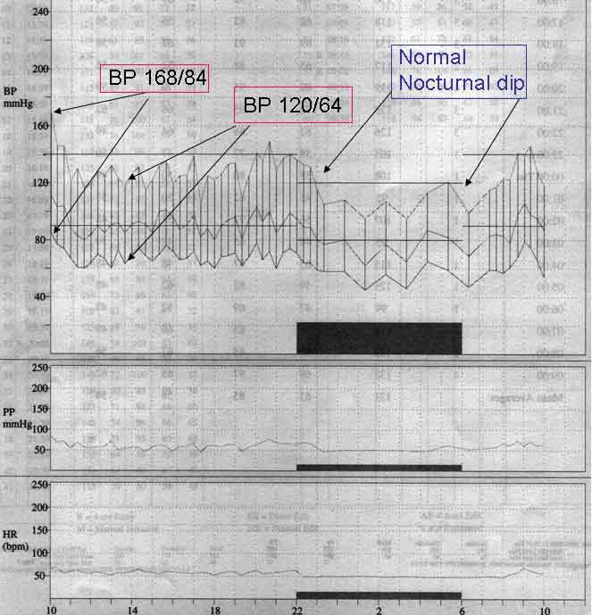 Graph of an Ambulatory BP recording showing some white coat hypertension in an otherwise normotensive individual