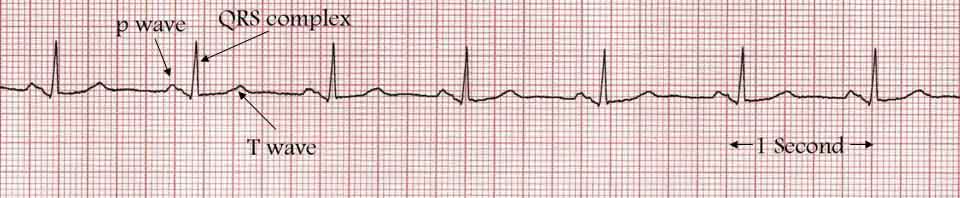 A normal heart tracing in sinus rhythm