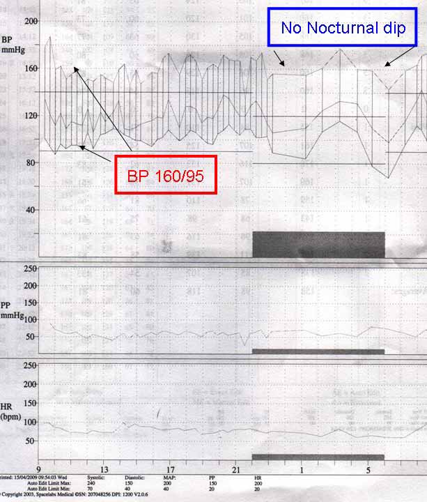Graph of an ambulatory 24 hour blood pressure monitor result on a patient with established hypertension. Not only is the blood pressure above the normal range throughout the day, there is also loss of the normal diurnal rhythm with no nocturnal dip.