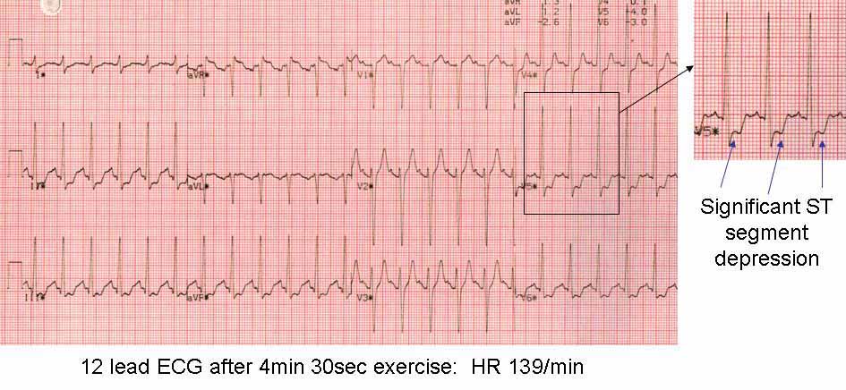 12 lead ECG at peak exercise test showing positive result with ST segment depression