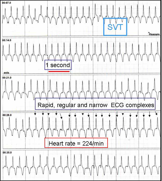 Print out of a external loop recording of a supraventricular tachycardia